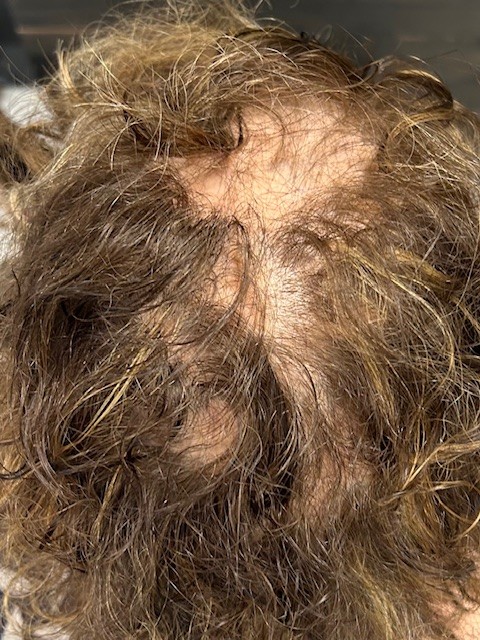 LICHEN PLANOPILARIS 3